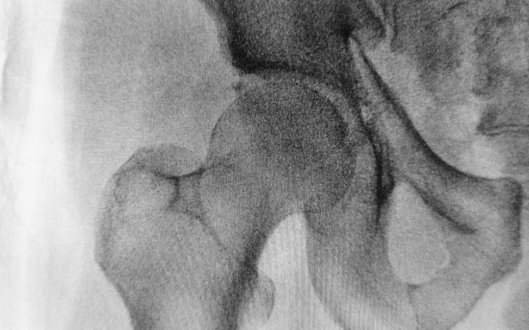 Cómo frenar la osteoporosis.